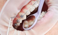 Orthodontic Treatment Orthodontic Treatment