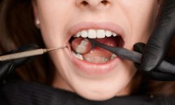 Cavity Fillings Cavity Fillings