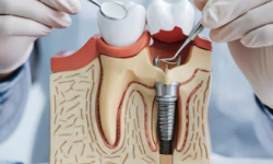 Root Canal Root Canal